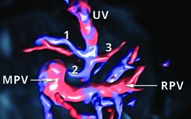 Prenatal diagnosis of infracardiac type of total…